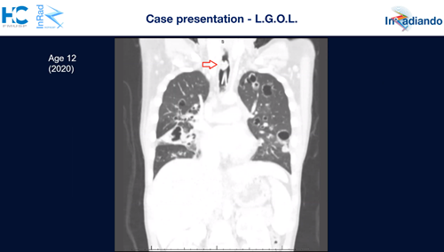 Recurrent Respiratory papillomatosis